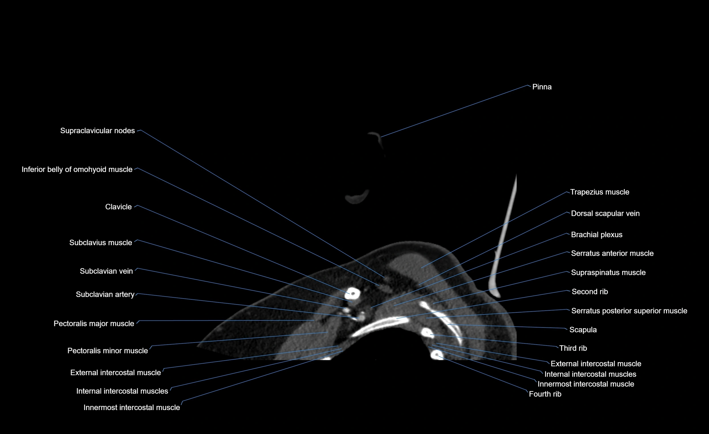 Neck CT sagittal cross sectional anatomy 3D  radiology  image-img-00001-00030.webp